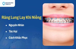 Răng Lung Lay Khi Niềng: Nguyên Nhân, Tác Hại, Cách Xử Lý