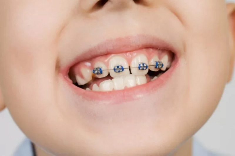 Độ tuổi thích hợp nhất để thực hiện niềng răng là từ 6 - 12 tuổi