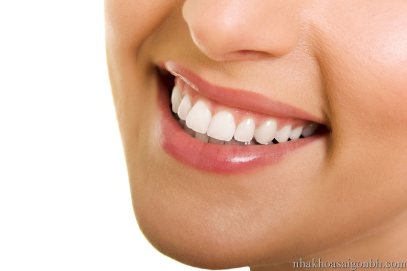 Niềng răng giúp khuôn mặt cân đối hơn khi trưởng thành