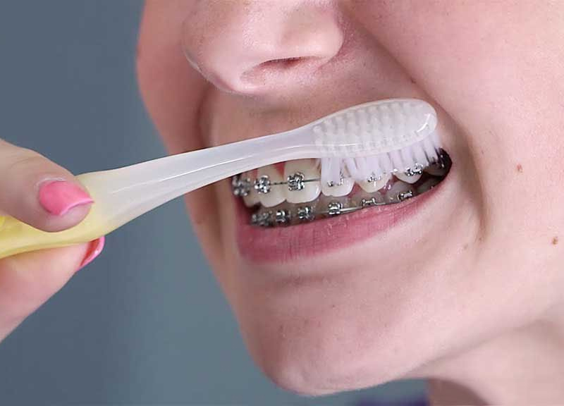 Vệ sinh răng khi niềng để đảm bảo hiệu quả chỉnh nha sau cùng