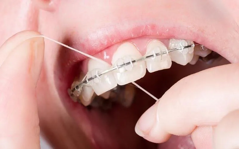 Cách vệ sinh răng niềng đúng chuẩn đó là sử dụng chỉ nha khoa thay cho tăm tre