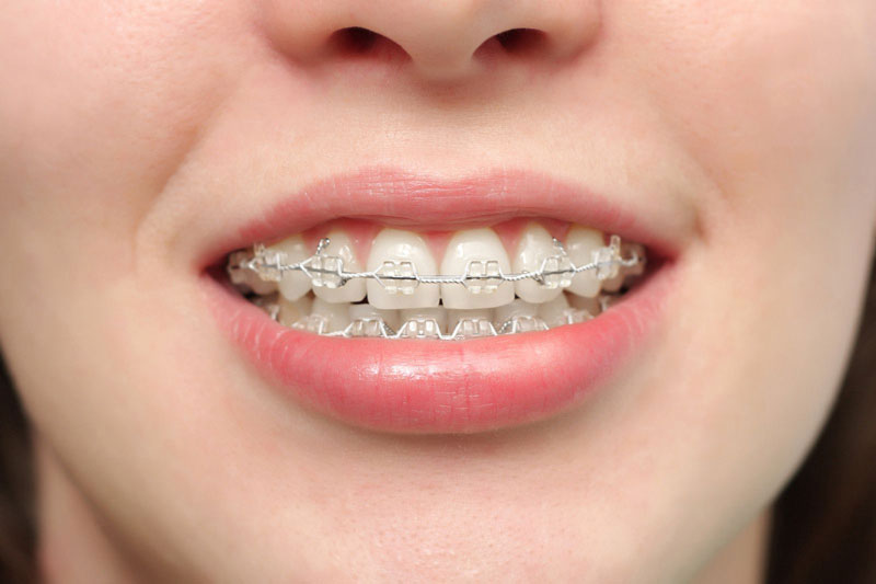 giai đoạn xấu nhất khi niềng răng sẽ nằm trong khoảng 3 tháng đầu tiên