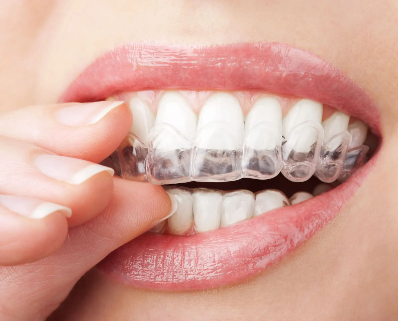 Bạn có thể lựa chọn phương pháp niềng răng trong suốt Invisalign để đảm bảo thẩm mỹ