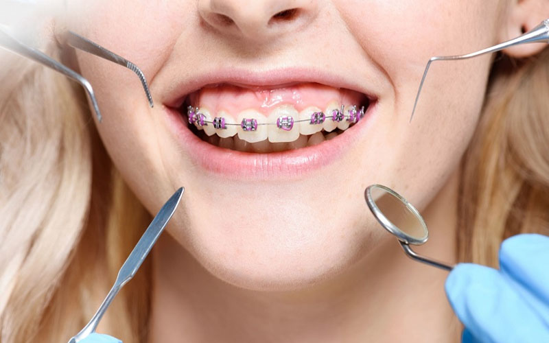 Tùy từng trường hợp niềng răng hô hàm có thể phải nhổ răng