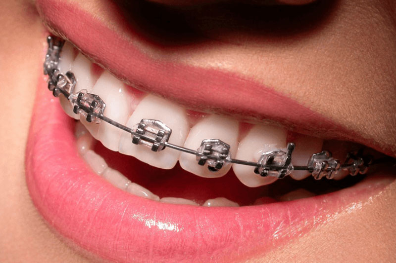 Niềng răng mắc cài thường là một phương pháp truyền thống