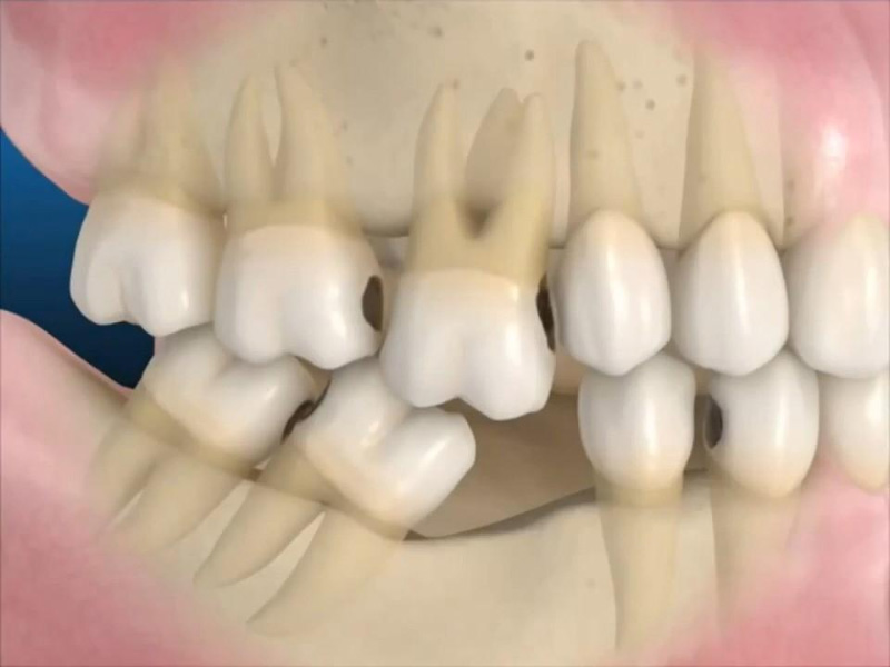 Việc mất đi răng hàm số 6 sẽ dẫn tới những hậu quả nghiêm trọng