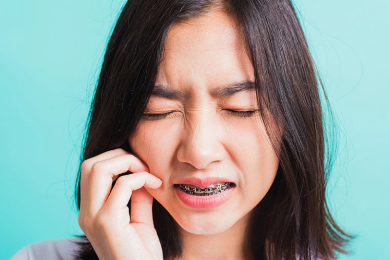 Khi mới niềng răng, cảm giác đau nhức sẽ kéo dài trong khoảng 7 – 10 ngày