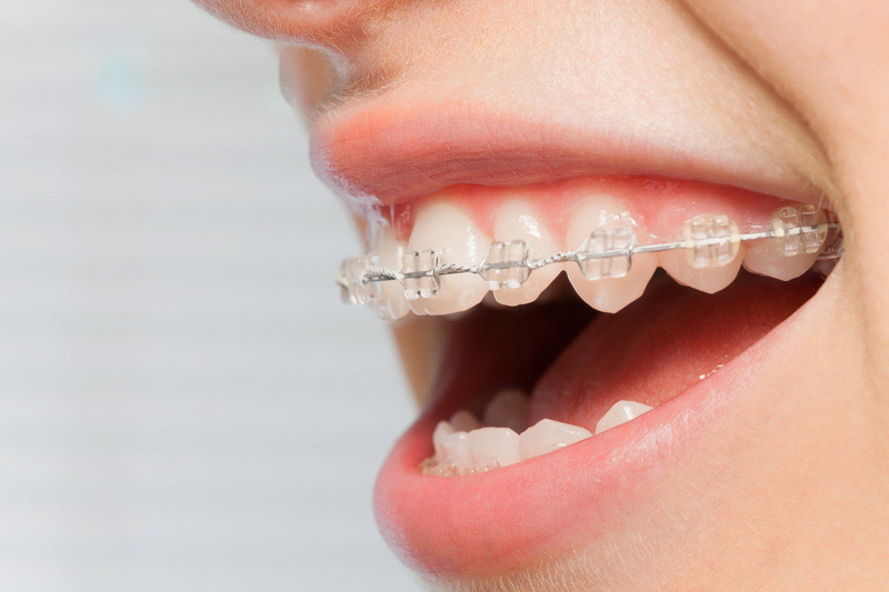 Thời gian niềng răng cho 1 hàm thường dao động từ 12 - 24 tháng