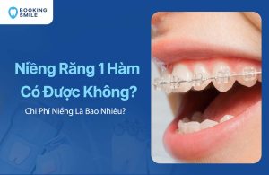 Niềng Răng 1 Hàm Có Được Không? Chi Phí Niềng Là Bao Nhiêu?