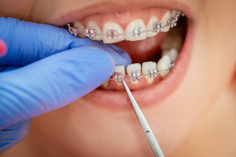 Giá niềng răng tại Bệnh viện thấp hơn dịch vụ ở nha khoa