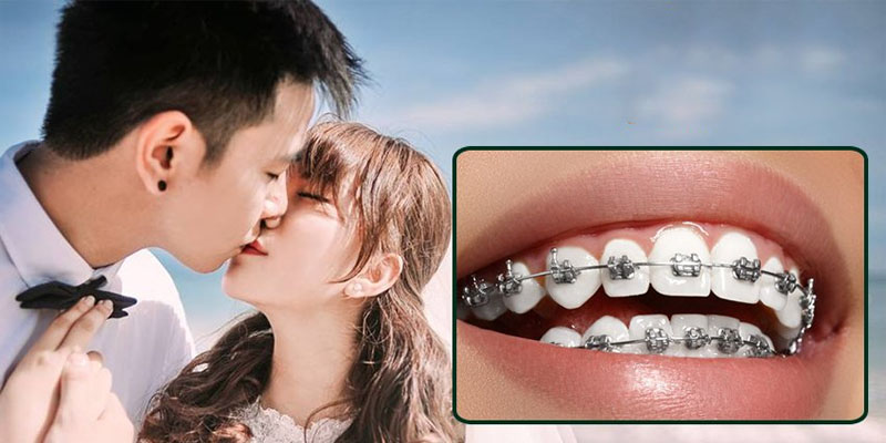 Niềng răng vẫn có thể hôn bình thường, tuy nhiên cần cẩn thận