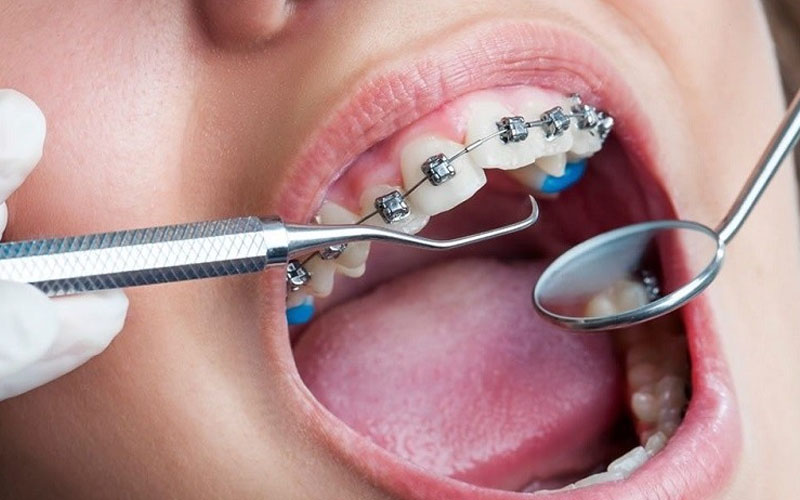 Niềng răng có làm răng yếu đi nếu bác sĩ thực hiện thiếu kỹ năng, kinh nghiệm