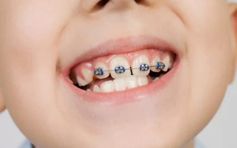 Quy trình niềng răng ở trẻ em sẽ diễn ra nhanh hơn so với người trưởng thành