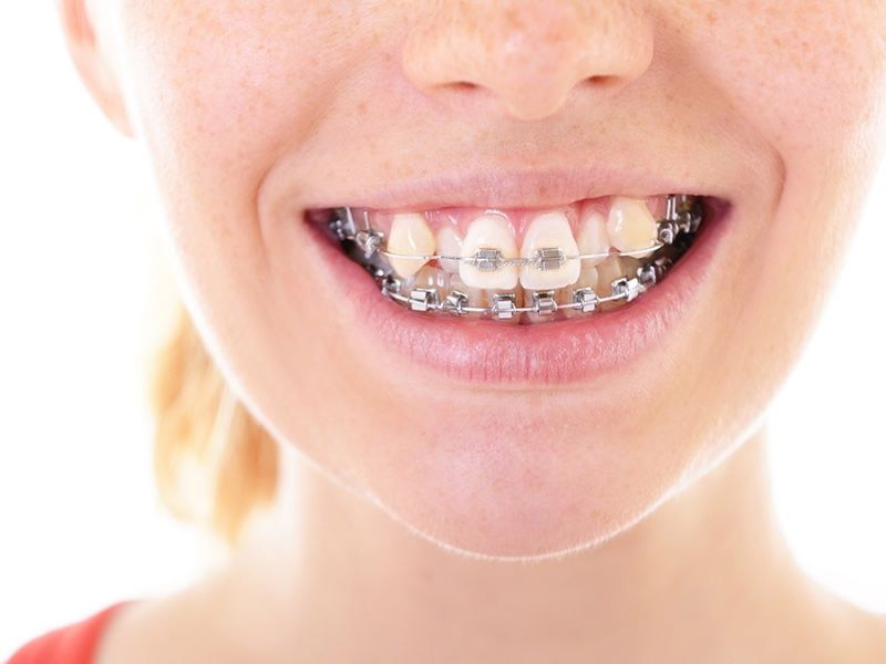 Niềng răng hoàn toàn có thể giữ lại răng khểnh