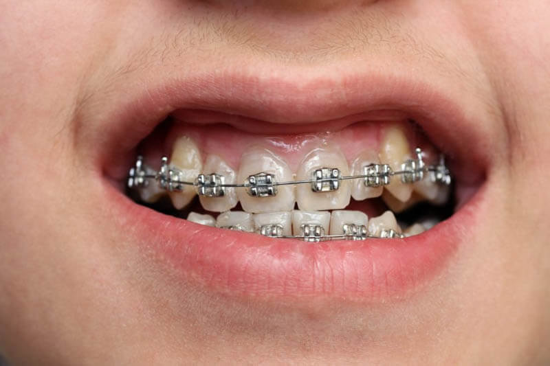 Niềng răng khểnh bằng mắc cài thường có chi phí thấp