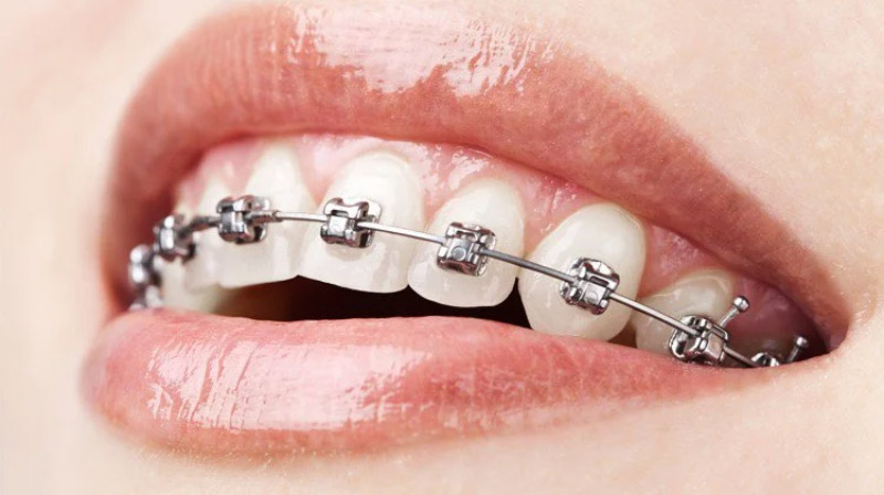 Niềng răng sẽ không làm tổn thương tới cấu trúc của răng