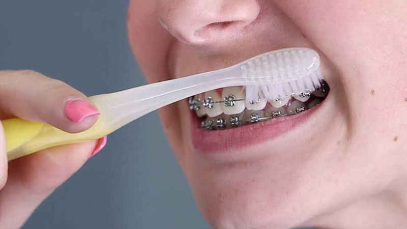 Bạn cần giữ vệ sinh răng miệng trong quá trình niềng